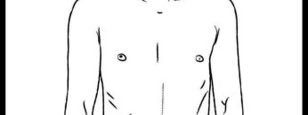 Stoma
