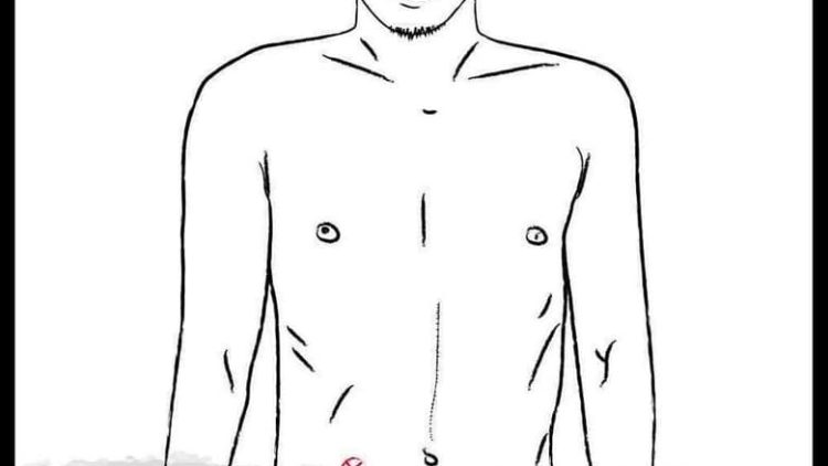 Stoma